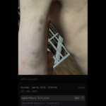 A photo shows bruising on an arm