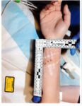injuries to Lindsay Clancy's hand